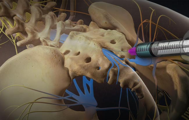Caudal Epidural Steroid Injection in Raleigh, North Carolina