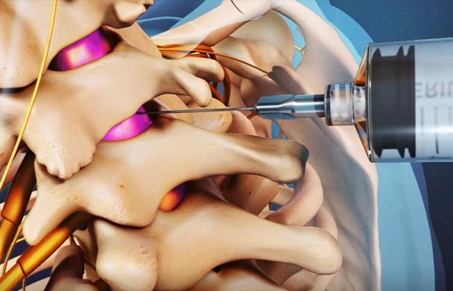 Cervical Epidural Steroid Injection in Raleigh, North Carolina