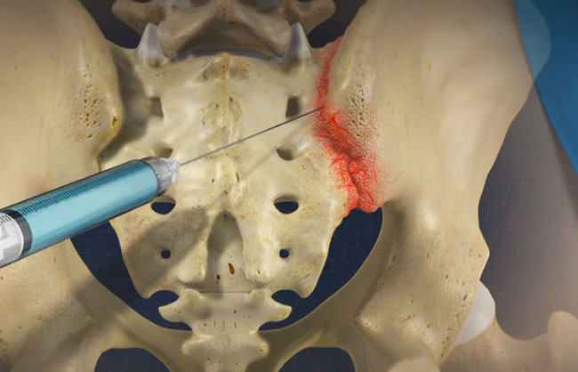 Sacroiliac Joint Injection in Raleigh, North Carolina