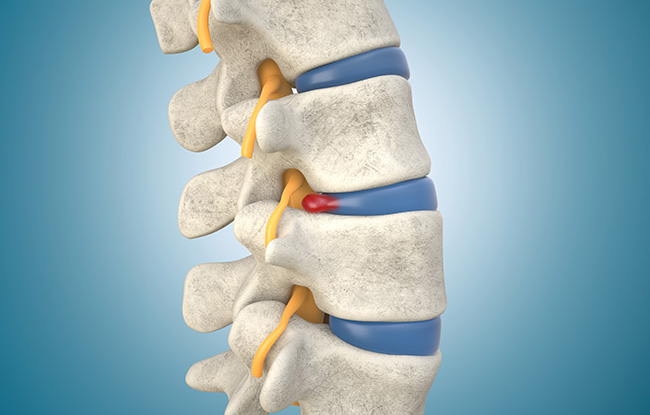 Patient undergoing Herniated Disc treatment at Advanced Pain Consultants, PA
