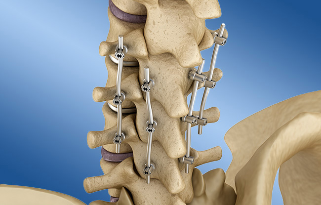 Patient undergoing Post Laminectomy Syndrome treatment at Advanced Pain Consultants, PA