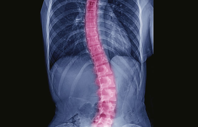 scoliosis in Raleigh, North Carolina