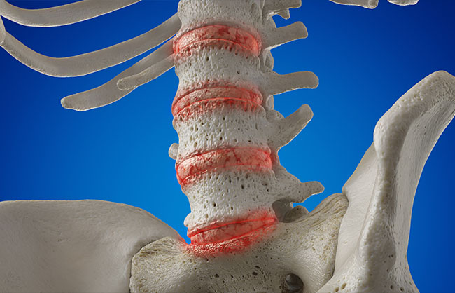 Spinal Arthritis in Raleigh, North Carolina