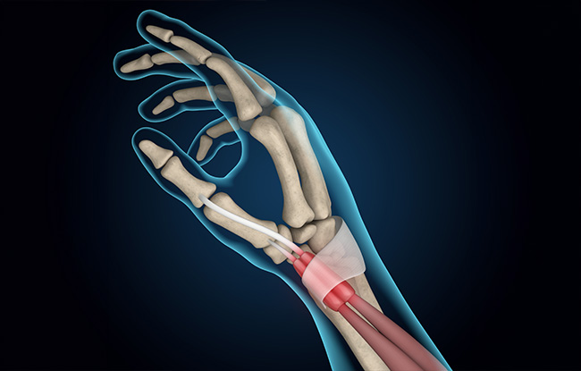 Patient undergoing Tendonitis treatment at Advanced Pain Consultants, PA