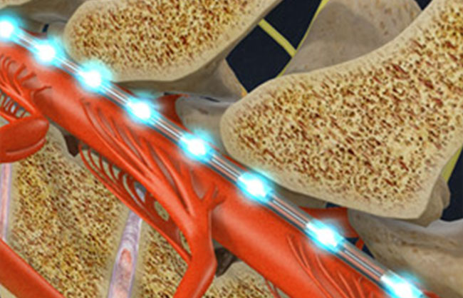 Spinal Cord Stimulator in Raleigh